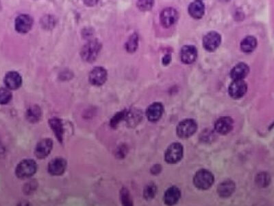 Resistência à insulina: sintomas da condição silenciosa pré-diabetes