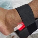 Evita amputações: brasileira cria aparelho que acelera a cicatrização de feridas em diabéticos