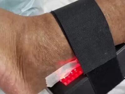 Evita amputações: brasileira cria aparelho que acelera a cicatrização de feridas em diabéticos
