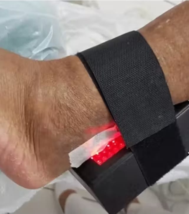 Evita amputações: brasileira cria aparelho que acelera a cicatrização de feridas em diabéticos