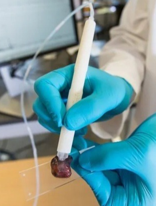 Pesquisadora brasileira cria caneta que detecta câncer em 10 segundos