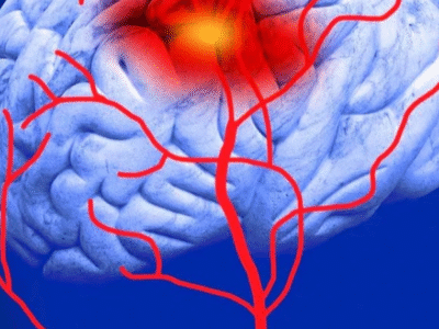 6 hábitos que aumentam o risco de AVC e como mudar, afirma médico