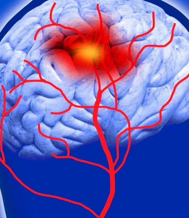 6 hábitos que aumentam o risco de AVC e como mudar, afirma médico
