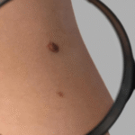 IA que ‘enxerga além da imagem’ detecta câncer de pele com precisão inédita