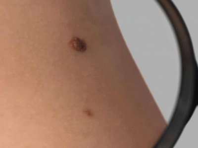 IA que ‘enxerga além da imagem’ detecta câncer de pele com precisão inédita