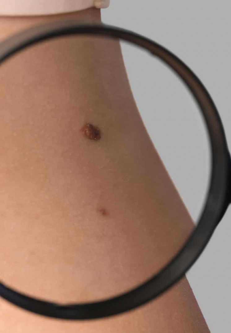 IA que ‘enxerga além da imagem’ detecta câncer de pele com precisão inédita