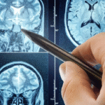 Famoso remédio para pressão alta surpreende ao impedir avanço de tumor cerebral