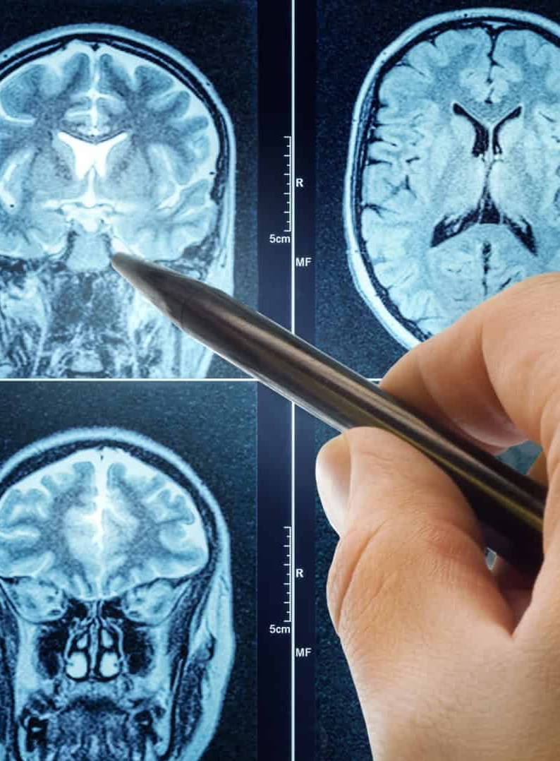 Famoso remédio para pressão alta surpreende ao impedir avanço de tumor cerebral