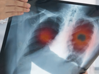 Vacina que previne câncer de pulmão será testada em humanos