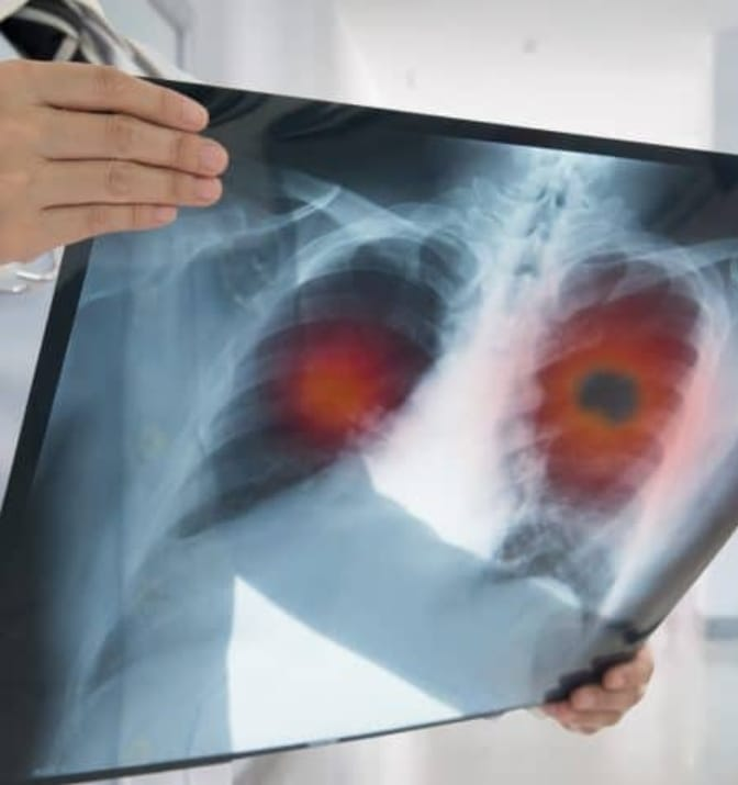 Vacina que previne câncer de pulmão será testada em humanos