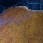 Saiba qual é a melhor estratégia para eliminar a gordura no fígado