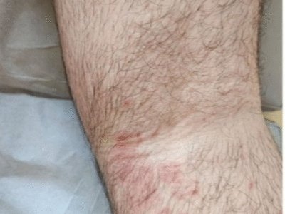 ‘Superfungo’ genital se espalha e coloca autoridades em estado de alerta