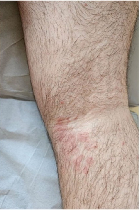 ‘Superfungo’ genital se espalha e coloca autoridades em estado de alerta