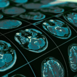 Cientistas mapeiam onde começam as alterações cerebrais na esquizofrenia