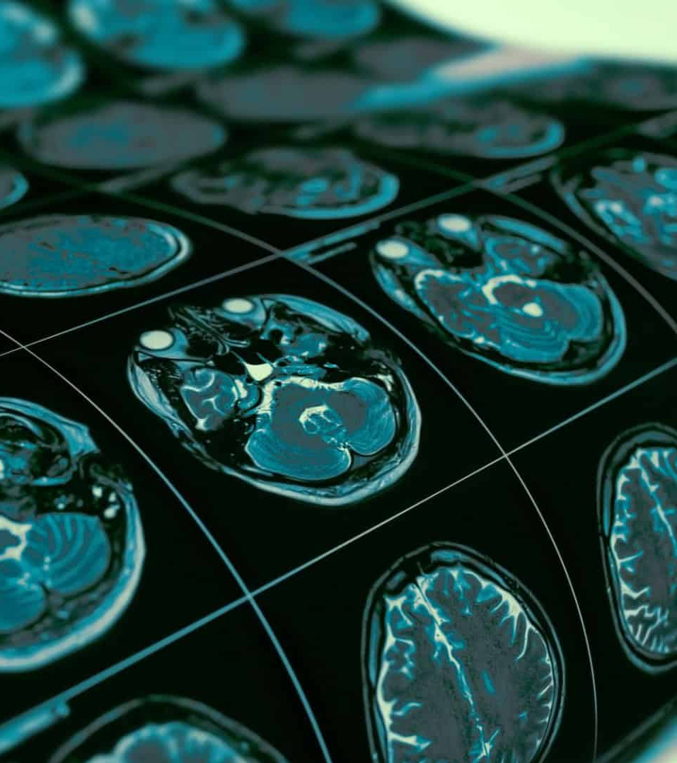 Cientistas mapeiam onde começam as alterações cerebrais na esquizofrenia