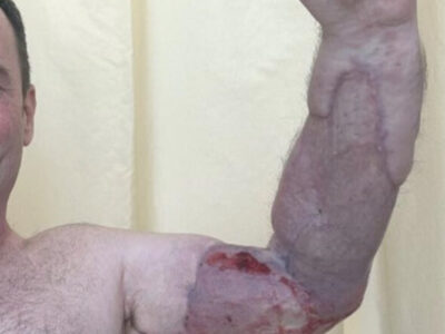 Homem quase perde o braço por bactéria após se machucar na academia