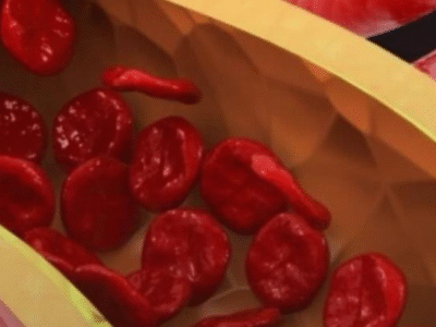 Cardiologista apontam o que precisa ser feito para ‘limpar’ as artérias; VEJA