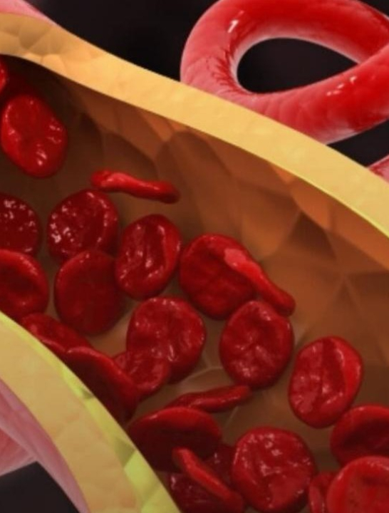 Cardiologista apontam o que precisa ser feito para ‘limpar’ as artérias; VEJA