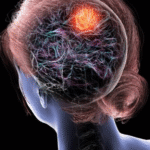 Dr. Cesar Cimonari, Neurocirurgião: Sintomas de gliomas que você não deve ignorar