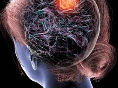 Dr. Cesar Cimonari, Neurocirurgião: Sintomas de gliomas que você não deve ignorar