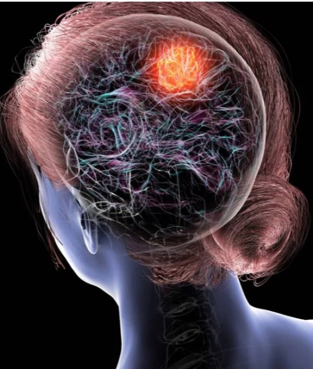 Dr. Cesar Cimonari, Neurocirurgião: Sintomas de gliomas que você não deve ignorar