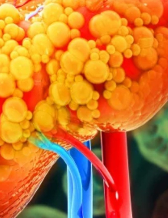 Nem álcool, nem hepatite: saiba o que aumentou as doenças do fígado