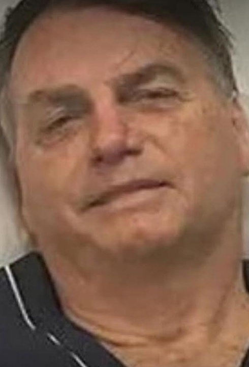 URGENTE: Bolsonaro diagnosticado com hérnias inguinais na PF: cirurgia é o único tratamento, diz equipe médica