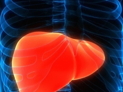Gordura no fígado: como identificar os sintomas da doença silenciosa