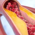 Estudo diz o que comer para evitar doenças cardíacas e colesterol alto