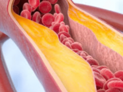 Estudo diz o que comer para evitar doenças cardíacas e colesterol alto