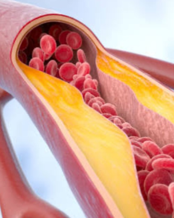 Estudo diz o que comer para evitar doenças cardíacas e colesterol alto
