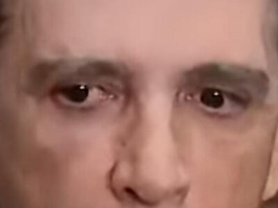 Exames confirmam traumatismo craniano em Bolsonaro diz médico; VEJA VIDEO