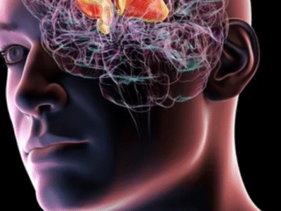 Neurocirurgião cita como o chá e o café ajudam a reduzir risco de AVC