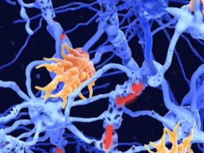 Estudo identifica 2 novos tipos de esclerose múltipla com ajuda da IA