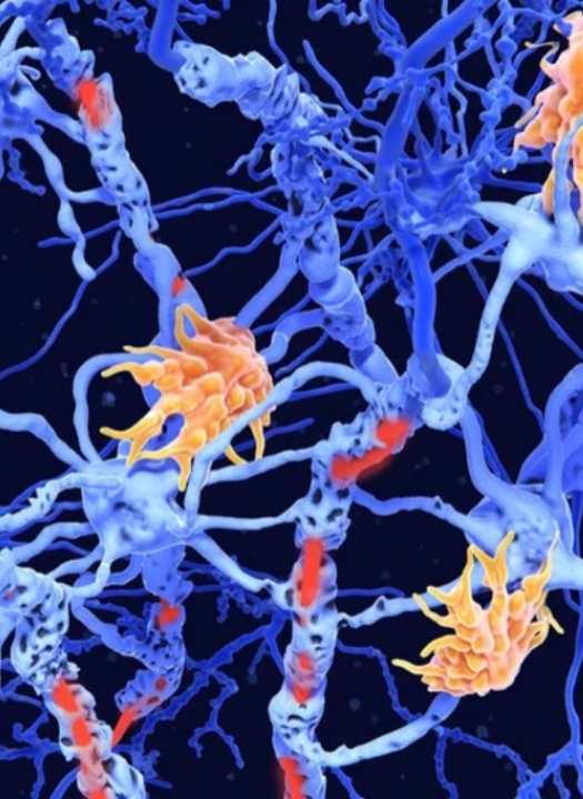 Estudo identifica 2 novos tipos de esclerose múltipla com ajuda da IA