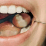 Uso regular de fio dental pode reduzir risco de AVC, aponta estudo