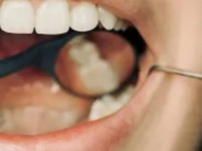 Uso regular de fio dental pode reduzir risco de AVC, aponta estudo