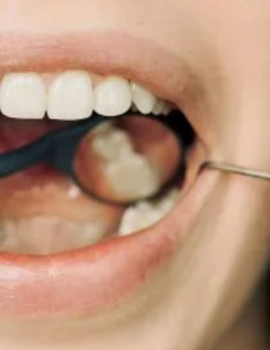 Uso regular de fio dental pode reduzir risco de AVC, aponta estudo