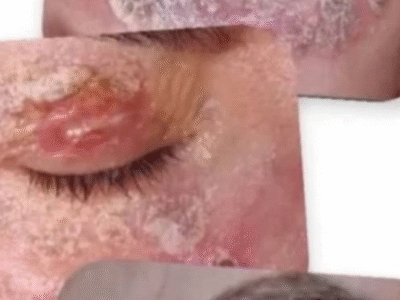 Psicanalista faz alerta após ter rosto queimado por procedimento