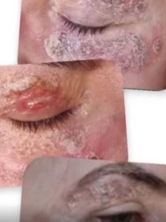 Psicanalista faz alerta após ter rosto queimado por procedimento