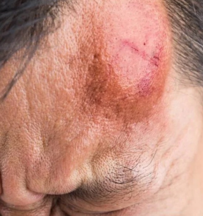 Entenda os riscos invisíveis que podem surgir dias depois de uma Pancada na Cabeça