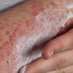 Alto custo faz Ministério da Saúde descartar vacina contra herpes-zóster no SUS