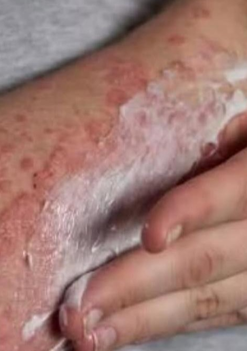Alto custo faz Ministério da Saúde descartar vacina contra herpes-zóster no SUS