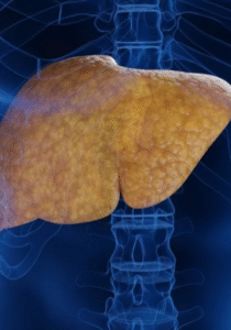 Gordura no fígado? Açúcar pode ser o verdadeiro vilão da doença