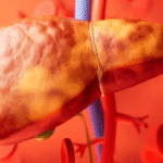 Hepatologista explica o que mais tende a provocar o colapso do fígado