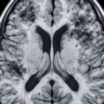 Pesquisa de Harvard indica que hábitos simples podem reduzir risco de Alzheimer; SAIBA QUAIS