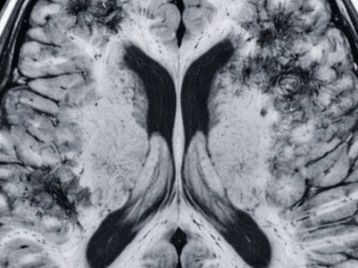 Pesquisa de Harvard indica que hábitos simples podem reduzir risco de Alzheimer; SAIBA QUAIS