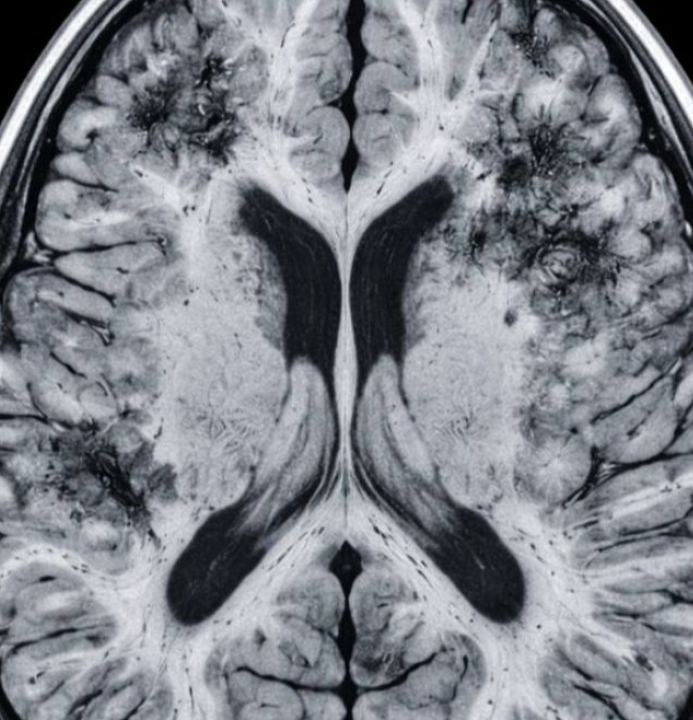 Pesquisa de Harvard indica que hábitos simples podem reduzir risco de Alzheimer; SAIBA QUAIS