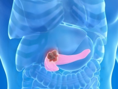 Combinação tripla elimina câncer de pâncreas em testes