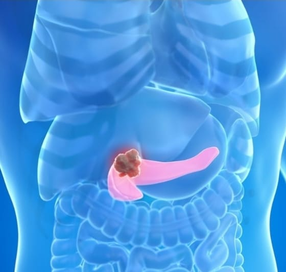 Combinação tripla elimina câncer de pâncreas em testes